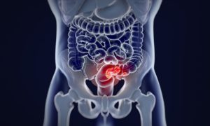 Is Colorectal Cancer screening effective?