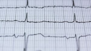 Correcting A Potentially Fatal Heart Rhythm 300x169, Health Channel