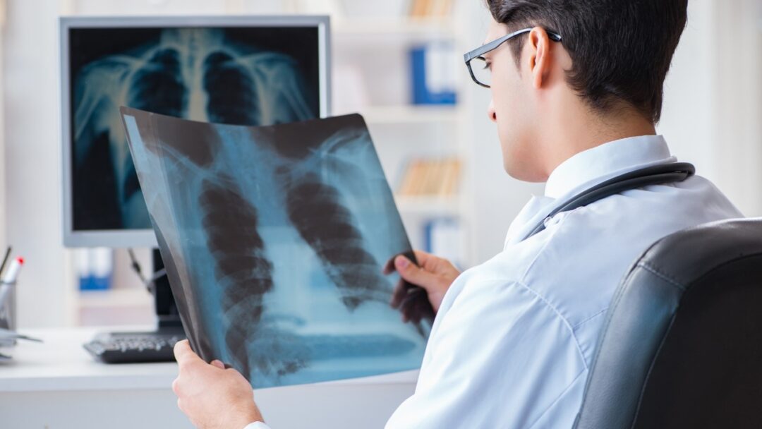 Catching Lung Cancer Early