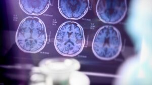 New Alzheimer’s Treatments on the Horizon