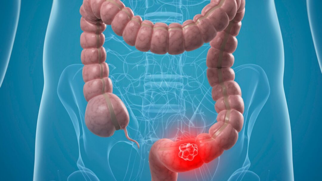 The Importance of Regular Colon Cancer Check Ups